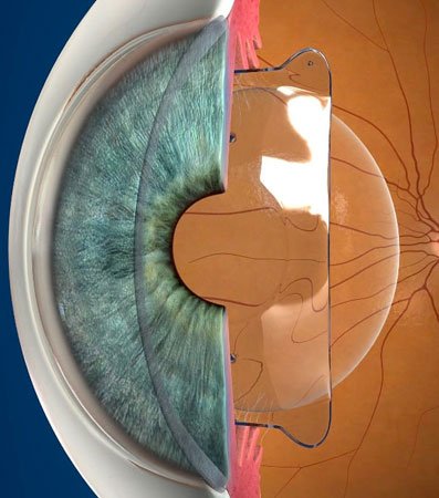 Best ICL Lens Surgery Hospital In Ghaziabad Manav Hospital